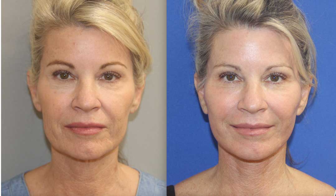 Facelift before and after photos